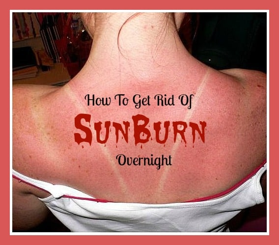 How to Get Rid of a Sunburn Overnight